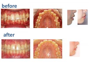 汐留シティセンター歯科　矯正治療