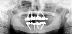 All-on-4最終補綴物装着後パノラマX線