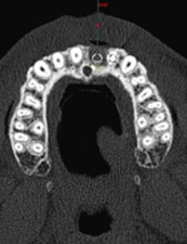 ブロック骨移植 抜歯後CT撮影 2-2