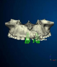 ブロック骨移植 3D画像を構築する