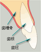 ブロック骨移植01