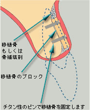 ブロック骨移植03