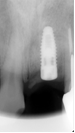 ブロック骨移植 インプラント埋入後X線写真