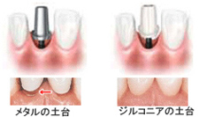 上部構造（かぶせもの）の作成・装着