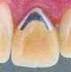 臼歯メタルボンドクラウン03