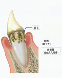 汐留シティセンター歯科　歯周病治療　歯周病の歯茎の状態