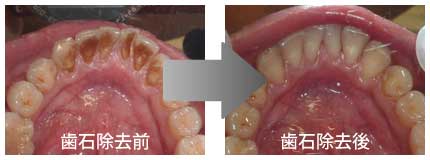 縁下歯石の除去