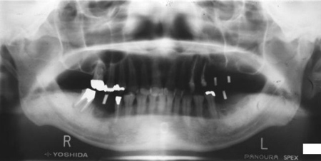 サイナスリフト 術前パノラマX線写真