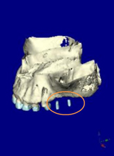 サイナスリフト 左上に２本のインプラントを計画