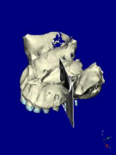 サイナスリフト 第二小臼歯部