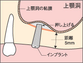 ソケットリフト（クレスタルアプローチ）